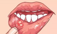 口腔溃疡能抽电子烟吗?只能说影响不大