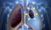 抽电子烟会导致气胸吗?先了解下气胸