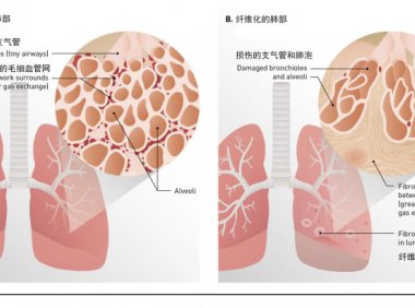 抽悦刻肺会纤维化吗？电子烟会导致肺纤维化吗？