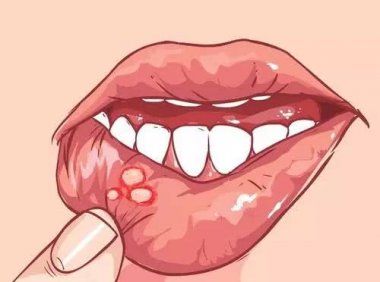 口腔溃疡能抽电子烟吗?只能说影响不大