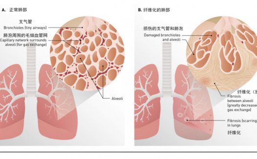 抽悦刻肺会纤维化吗？电子烟会导致肺纤维化吗？