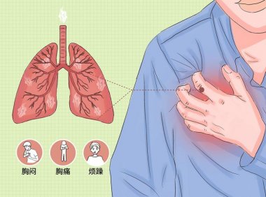 抽电子烟把肺抽爆了?(抽电子烟肺会爆炸吗)